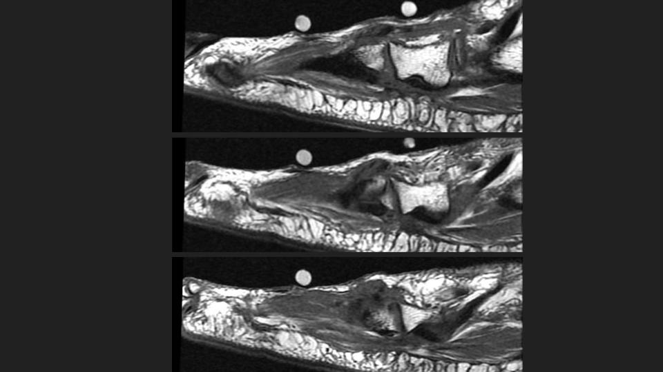 Figure 5 for case peroneus tertius ( RID2915 )